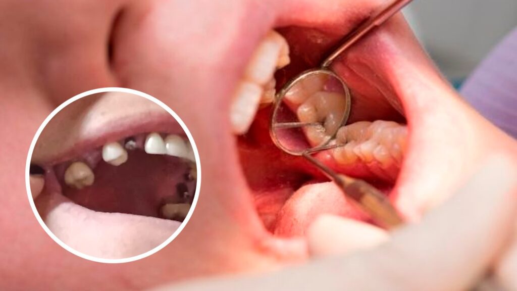 Caries sin curar puede hacerte perder tus dientes