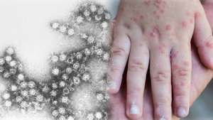 Callao: Cómo detectar y qué hacer ante el virus Coxsackie en escolares chalacos