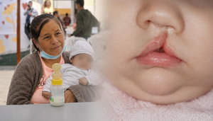 INSN anuncia «Sonrisatón»: campaña gratuita de cirugía para niños con labio y paladar hendido